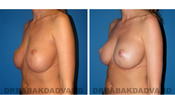 Before and After Photos |Revision Breast| - 27 year old female, - left side, oblique view