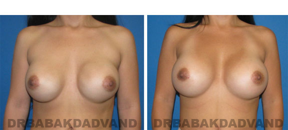 Before and After Photos |Revision Breast| - 37 year old female, - front view