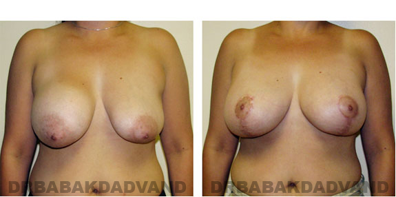 Before and After Photos |Revision Breast| - 41 year old female, - front view