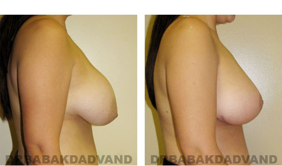 Before and After Photos |Revision Breast| - 41 year old female, - right side view