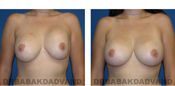 Before and After Photos |Revision Breast| - 24 year old female, - front view