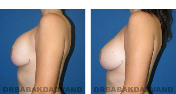 Before and After Photos |Revision Breast| - 24 year old female, - left side view