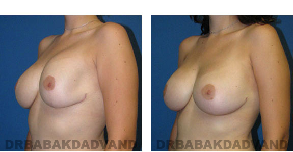 Before and After Photos |Revision Breast| - 24 year old female, - left side, oblique view