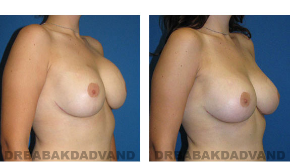 Before and After Photos |Revision Breast| - 24 year old female, - right side, oblique view
