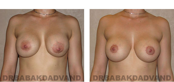 Before and After Photos |Revision Breast| - 25 year old female, - front view