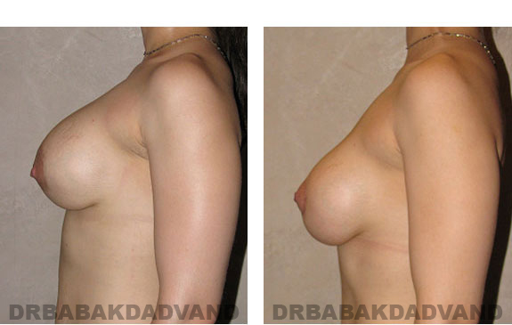 Before and After Photos |Revision Breast| - 25 year old female, - left side view