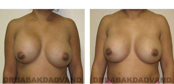 Before and After Photos |Revision Breast| - 28 year old female, - front view
