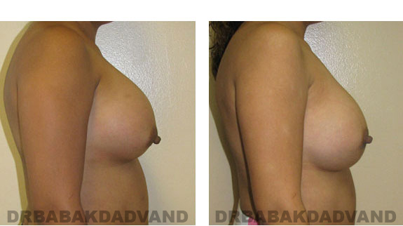 Before and After Photos |Revision Breast| - 28 year old female, - right side view