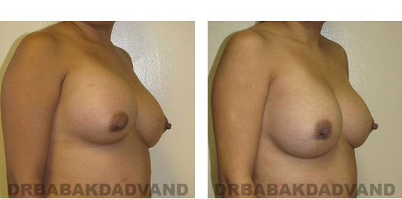 Before and After Photos |Revision Breast| - 28 year old female, - right side, oblique view