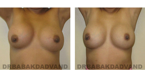 Before and After Photos |Revision Breast| - 28 year old female, - front view (hands up)