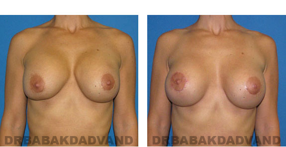 Before and After Photos |Revision Breast| - 42 year old female, - front view