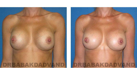 Before and After Photos |Revision Breast| 32 year old female, - front view