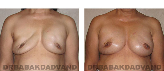 Before and After Photos |Revision Breast| 62 year old female, - front view