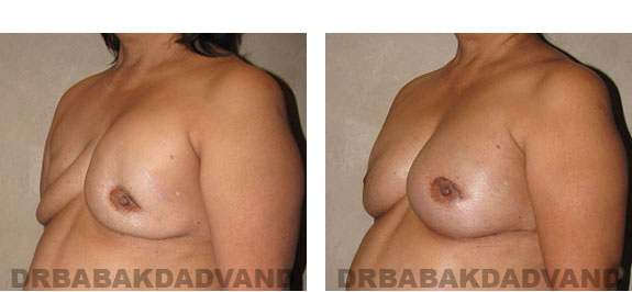 Before and After Photos |Revision Breast| 62 year old female, - left side, oblique view