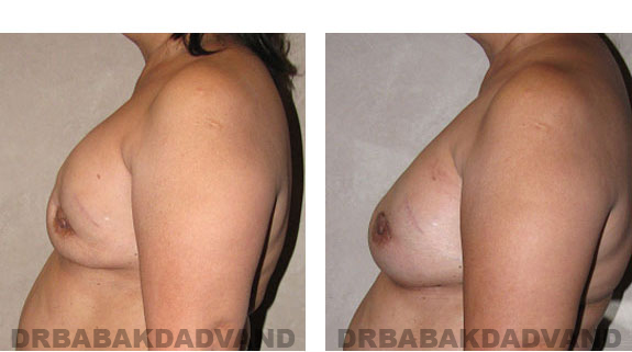 Before and After Photos |Revision Breast| 62 year old female, - left side view