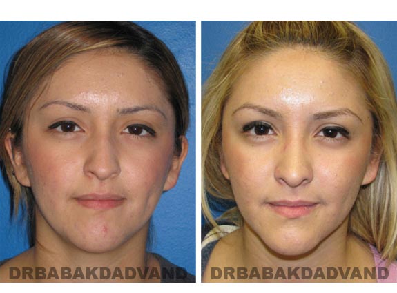 Before - After Photos |Rhinoplasty| 20 year old female, - front view