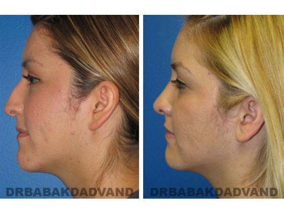 Before - After Photos |Rhinoplasty| 20 year old female, - left side view