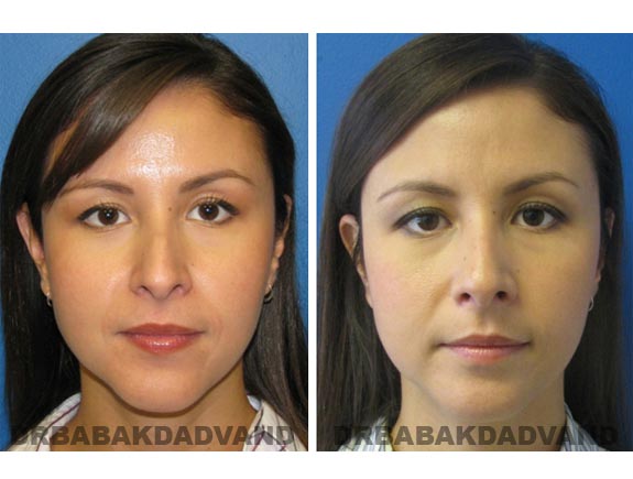 Before - After Photos |Rhinoplasty| 34 year old female, - front view