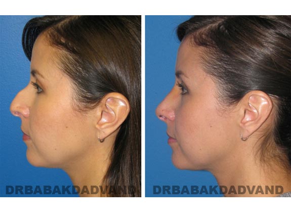 Before - After Photos |Rhinoplasty| 34 year old female, - left side view