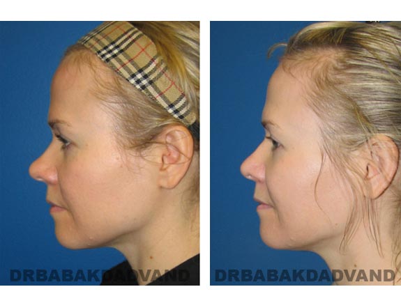 Before - After Photos |Rhinoplasty| 38 year old female, - left side view