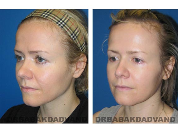 Before - After Photos |Rhinoplasty| 38 year old female, - left side,oblique view