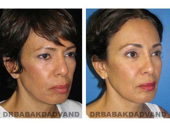 Before - After Photos |Rhinoplasty| 57 year old female, - right side,oblique view