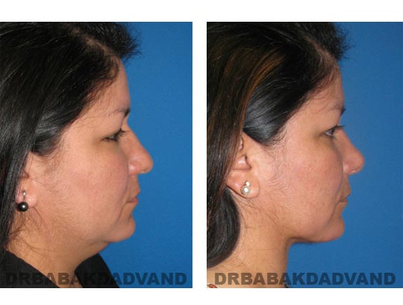 Before - After Photos |Rhinoplasty| 40 year old female, - right side view