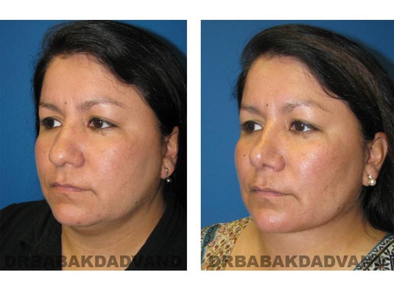 Before - After Photos |Rhinoplasty| 40 year old female, - left side,oblique view