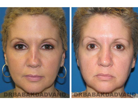 Before - After Photos |Rhinoplasty| 46 year old female, - front view