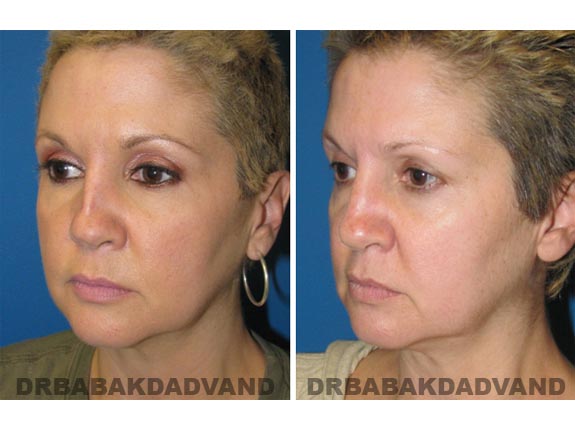 Before - After Photos |Rhinoplasty| 46 year old female, - left side,oblique view