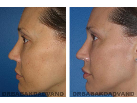 Before - After Photos |Rhinoplasty| 42 year old female, - right side view