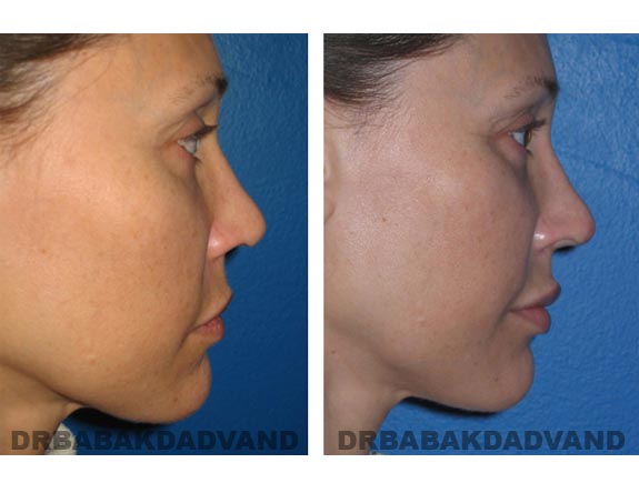 Before - After Photos |Rhinoplasty| 42 year old female, - left side view