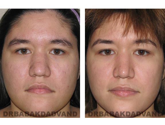 Before - After Photos |Rhinoplasty| 24 year old female, - front view