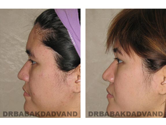 Before - After Photos |Rhinoplasty| 24 year old female, - left side view