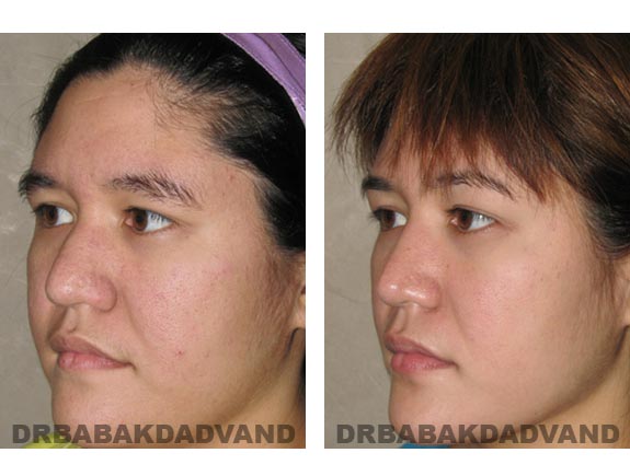 Before - After Photos |Rhinoplasty| 24 year old female, - left side,oblique view