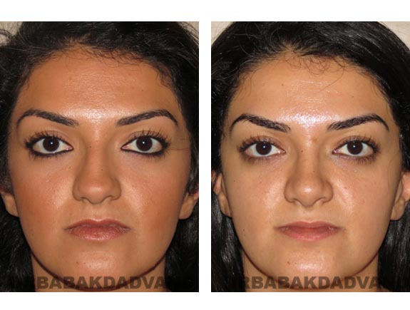 Before - After Photos |Rhinoplasty| 22 year old female, - front view