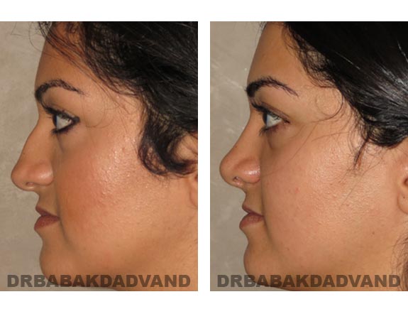 Before - After Photos |Rhinoplasty| 22 year old female, - left side view