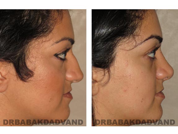 Before - After Photos |Rhinoplasty| 22 year old female, - right side view