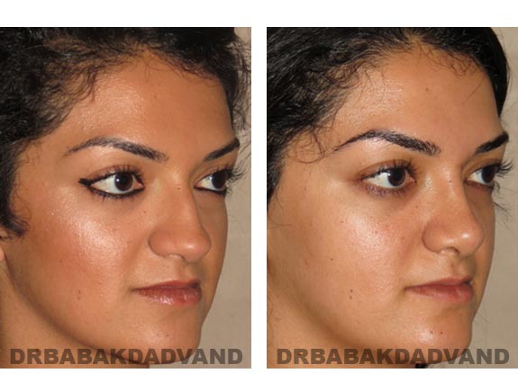 Before - After Photos |Rhinoplasty| 22 year old female, - right side,oblique view