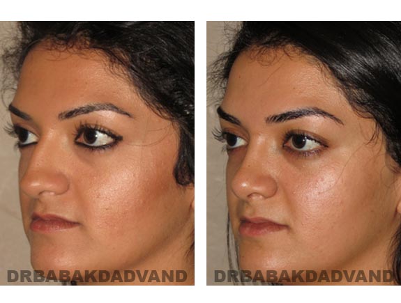 Before - After Photos |Rhinoplasty| 22 year old female, - left side,oblique view