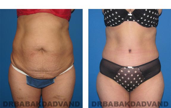 Before and After Photos |Tummy Tuck| 37 year old female, - front view