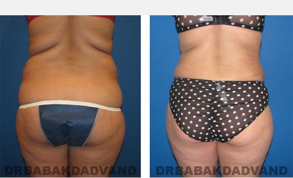 Before and After Photos |Tummy Tuck| 37 year old female, - back view