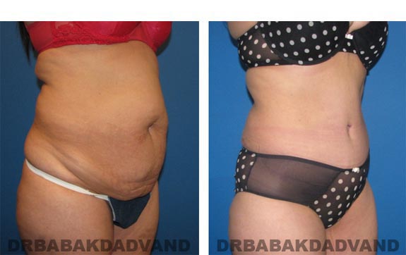 Before and After Photos |Tummy Tuck| 37 year old female, - right side, oblique view