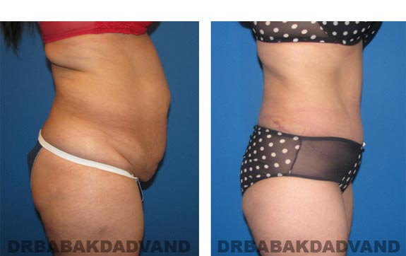 Before and After Photos |Tummy Tuck| 37 year old female, - right side view