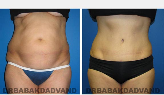 Before and After Photos |Tummy Tuck| 57 year old female, - front view