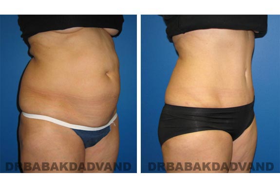 Before and After Photos |Tummy Tuck| 57 year old female, - right side, oblique view