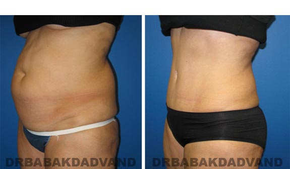 Before and After Photos |Tummy Tuck| 57 year old female, - left side, oblique view