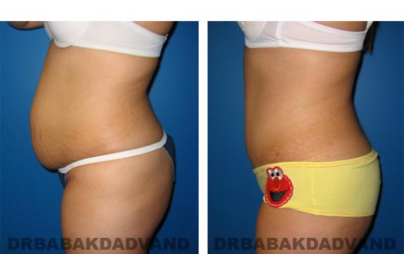 Before and After Photos |Tummy Tuck| 22 year old female, - left side view