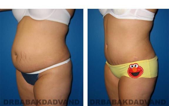 Before and After Photos |Tummy Tuck| 22 year old female, - left side, oblique view