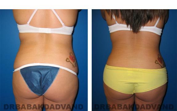 Before and After Photos |Tummy Tuck| 22 year old female, - back view